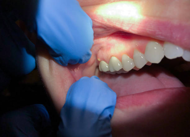 Best Emergency Treatment for Oral Infections in Maysville, OK